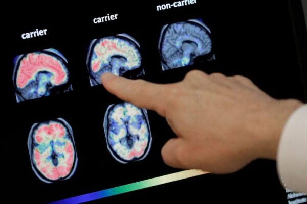 "Imagen: Transmisión de Alzheimer por Hormona de Crecimiento."